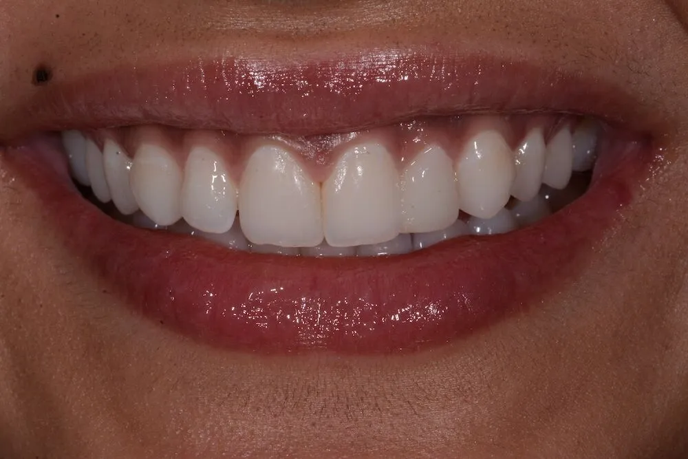 Before whitening treatment